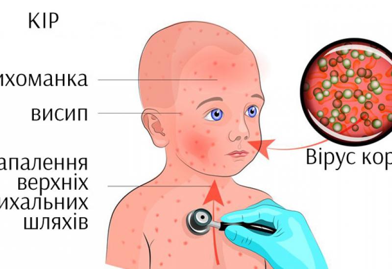 Caution –  measles!